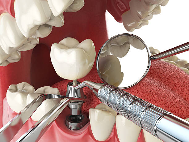 Best Emergency Root Canal Treatment in Boston, MA